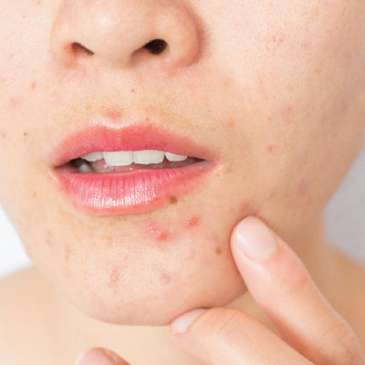 Understanding The Basics of Acne