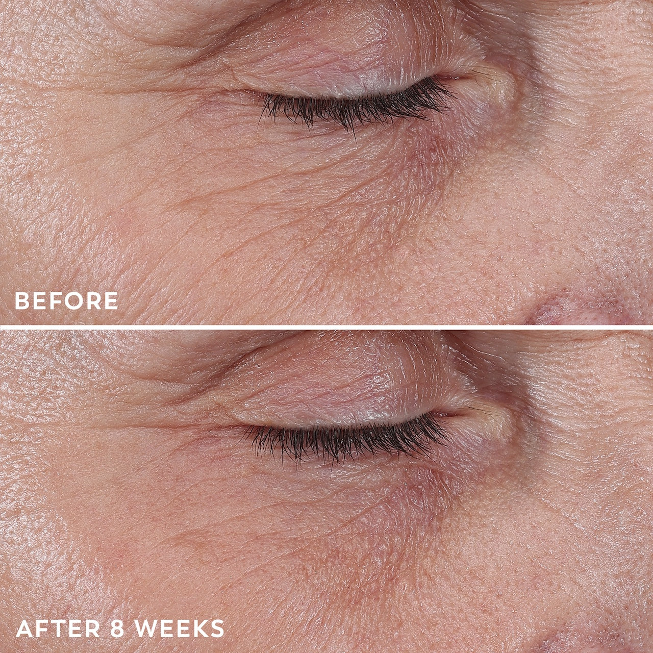 Model posing with before and after using Regenerist Eye Wrinkle Correcting Treatment on eyes for 8 weeks Model posing with before and after using Regenerist Eye Wrinkle Correcting Treatment on eyes for 8 weeks