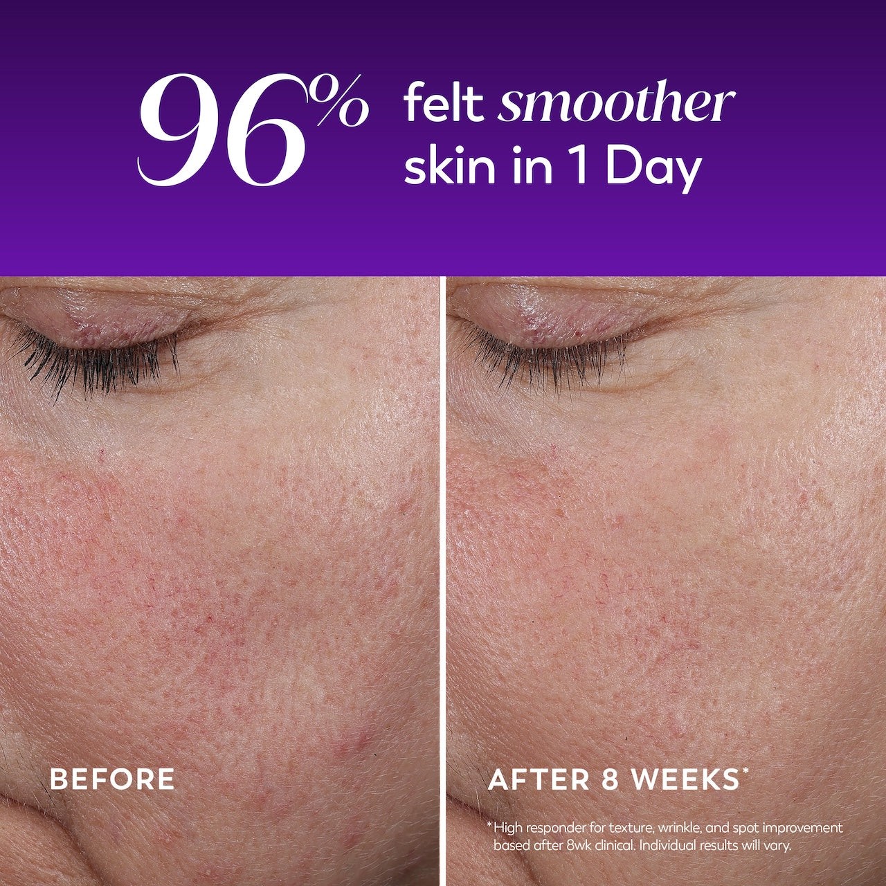 Images of Before and after 8 weeks applying Regenerist Wrinkle Correcting Night Treatment 96% felt smoother skin in 1 day. Images of Before and after 8 weeks applying Regenerist Wrinkle Correcting Night Treatment 96% felt smoother skin in 1 day.