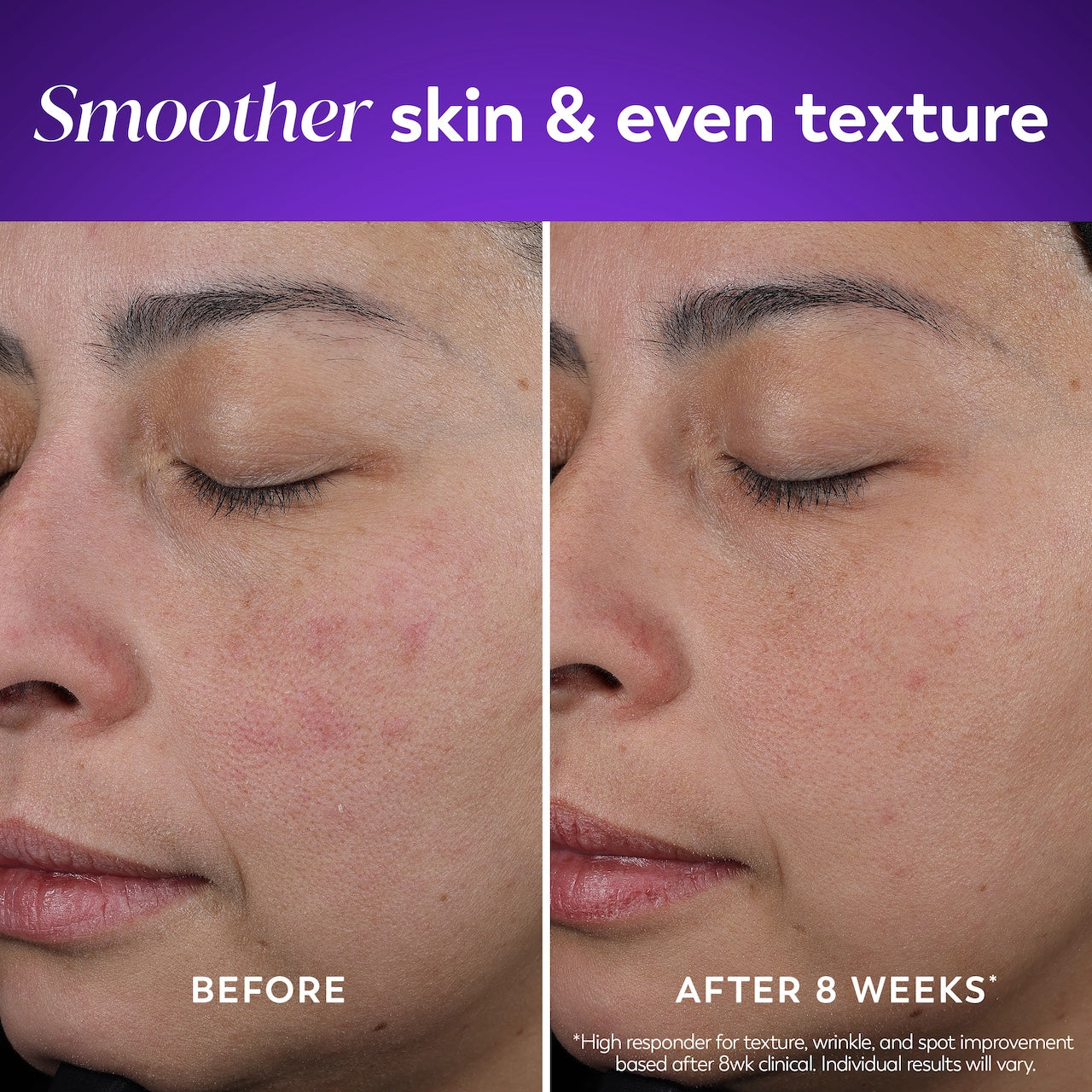 Model showing before and after using Retinol Face Moisturizer. Smoother skin and even skin texture Model showing before and after using Retinol Face Moisturizer. Smoother skin and even skin texture