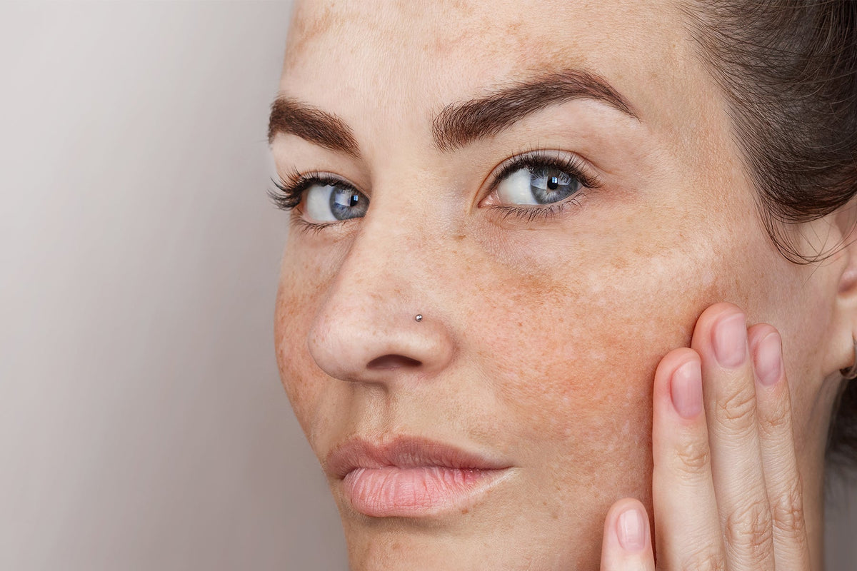 Hyperpigmentation Causes and Treatment Solutions
