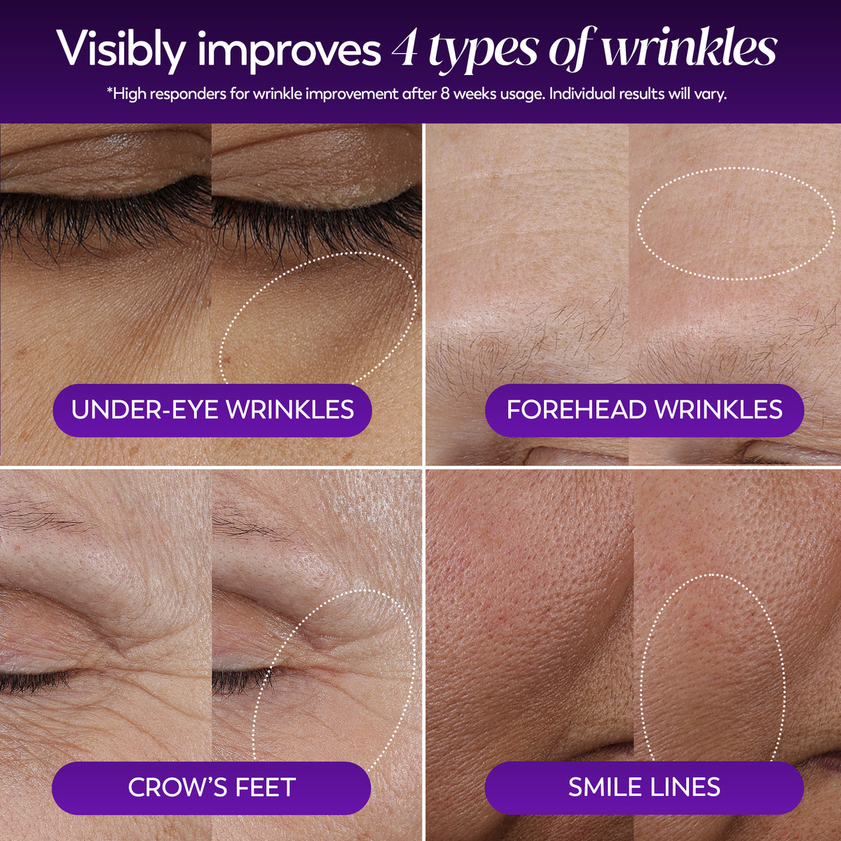 A four-panel before-and-after collage showing close-up skin results for under-eye wrinkles, forehead wrinkles, crow's feet, and smile lines. Purple labels identify each type, with dotted oval highlights over the wrinkled areas.