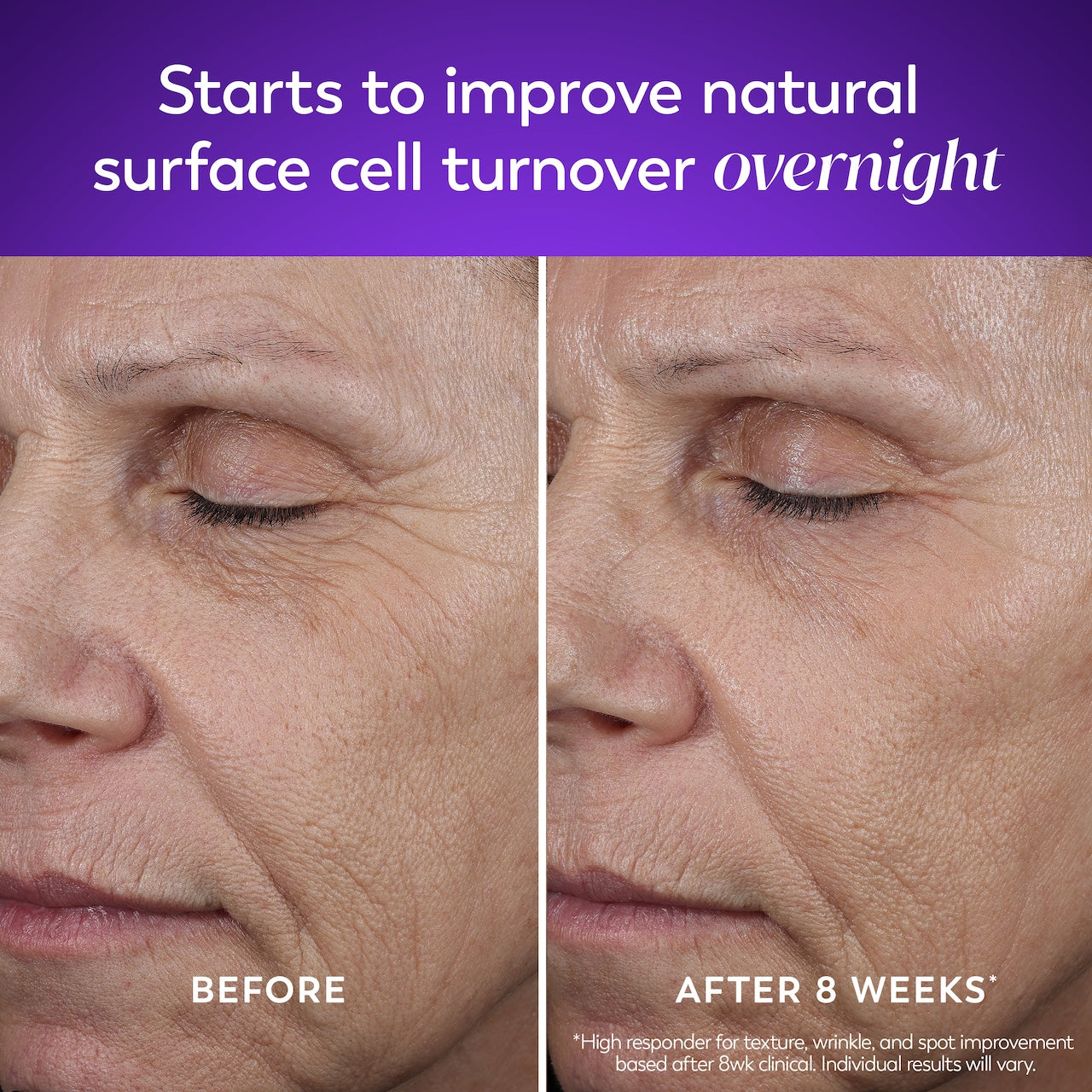 Model showing before and after using Retinol Max Face Moisturizer. Starts to improve natural surface cell turnover overnight