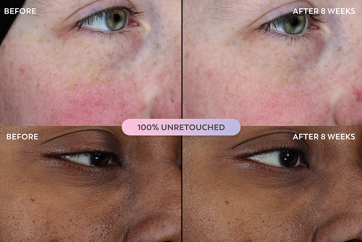 Before and after comparison of skin texture on a person's face, showing improvement over 8 weeks.