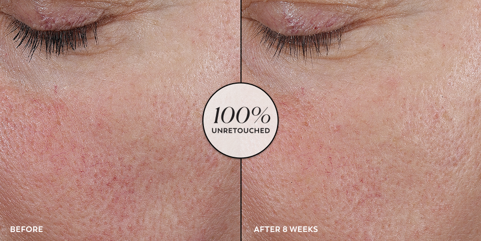 Before and after comparison of skin texture with a '100% Unretouched' label.
